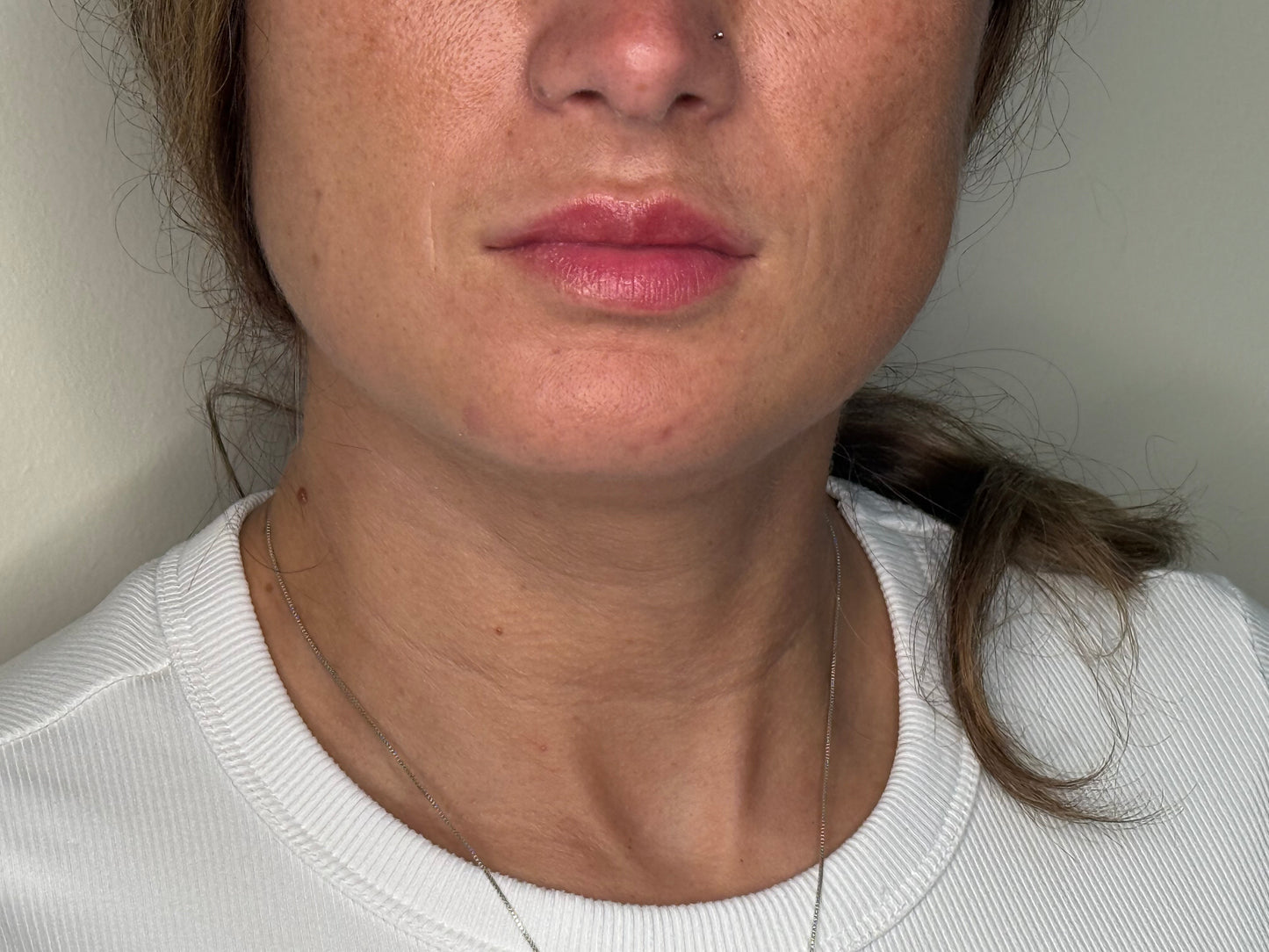 Fillers