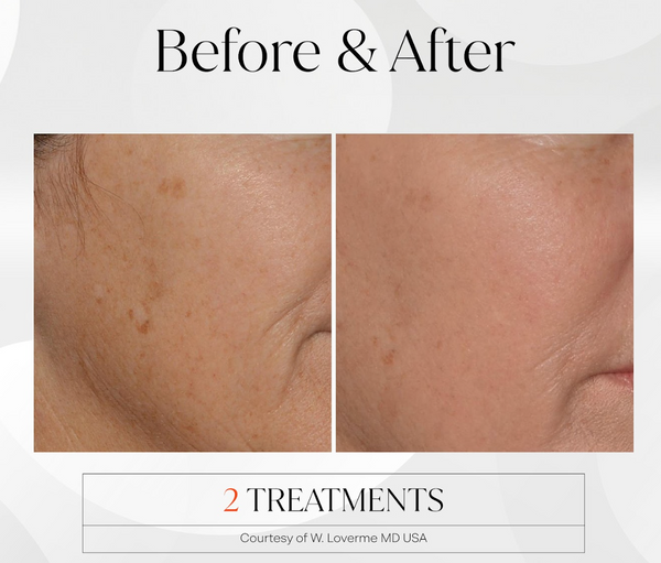 Fusion Treatment