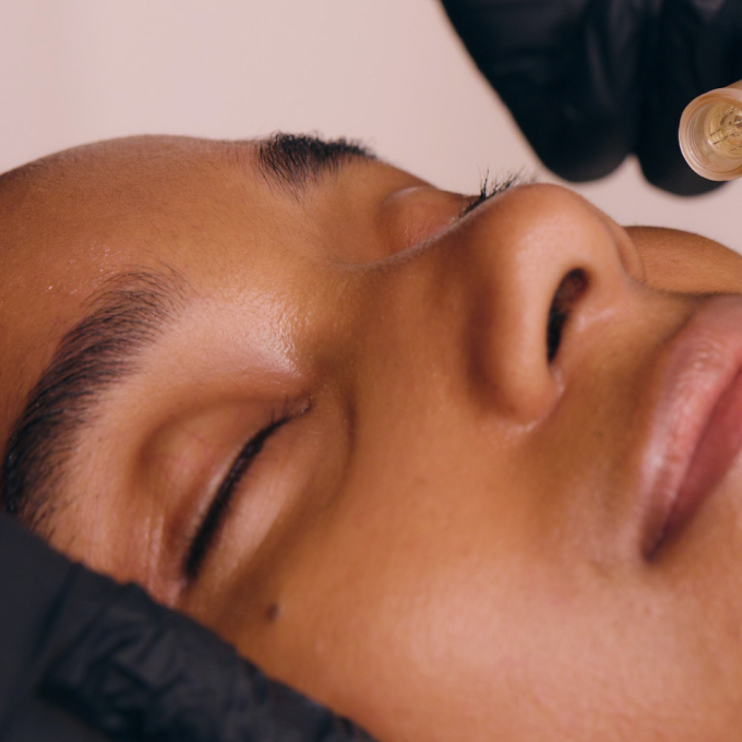 Potenza RF Microneedling