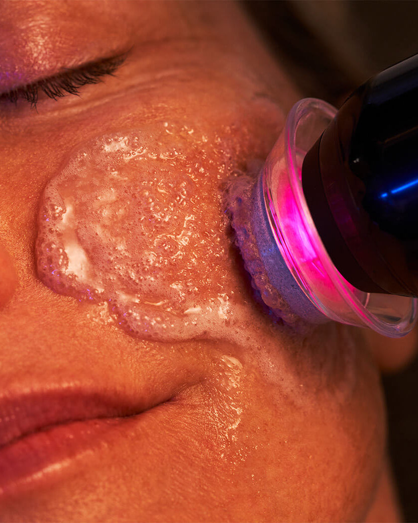 Close-up of a person receiving a skin treatment with a device on their face.