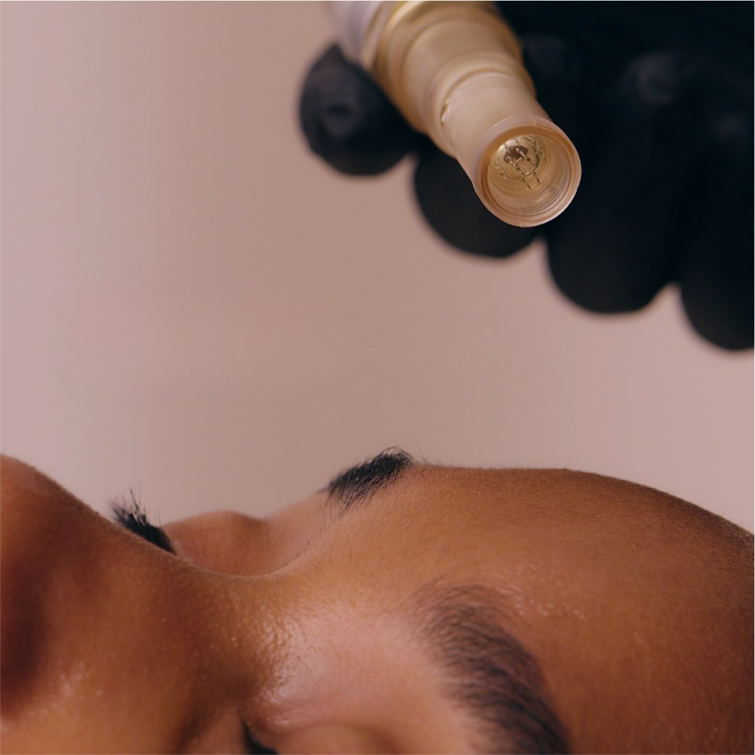 model getting microneedling