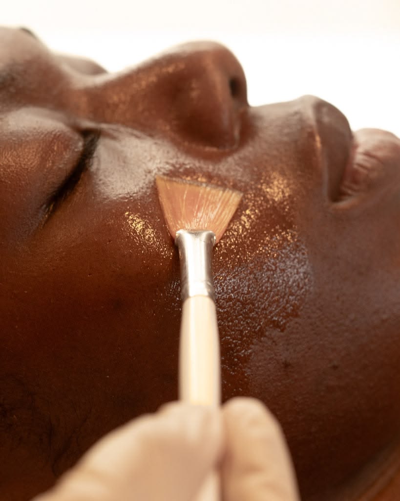 chemical peel model