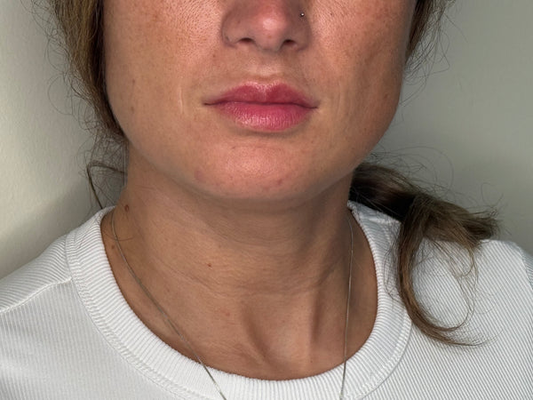 Fillers