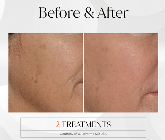 Fusion Treatment