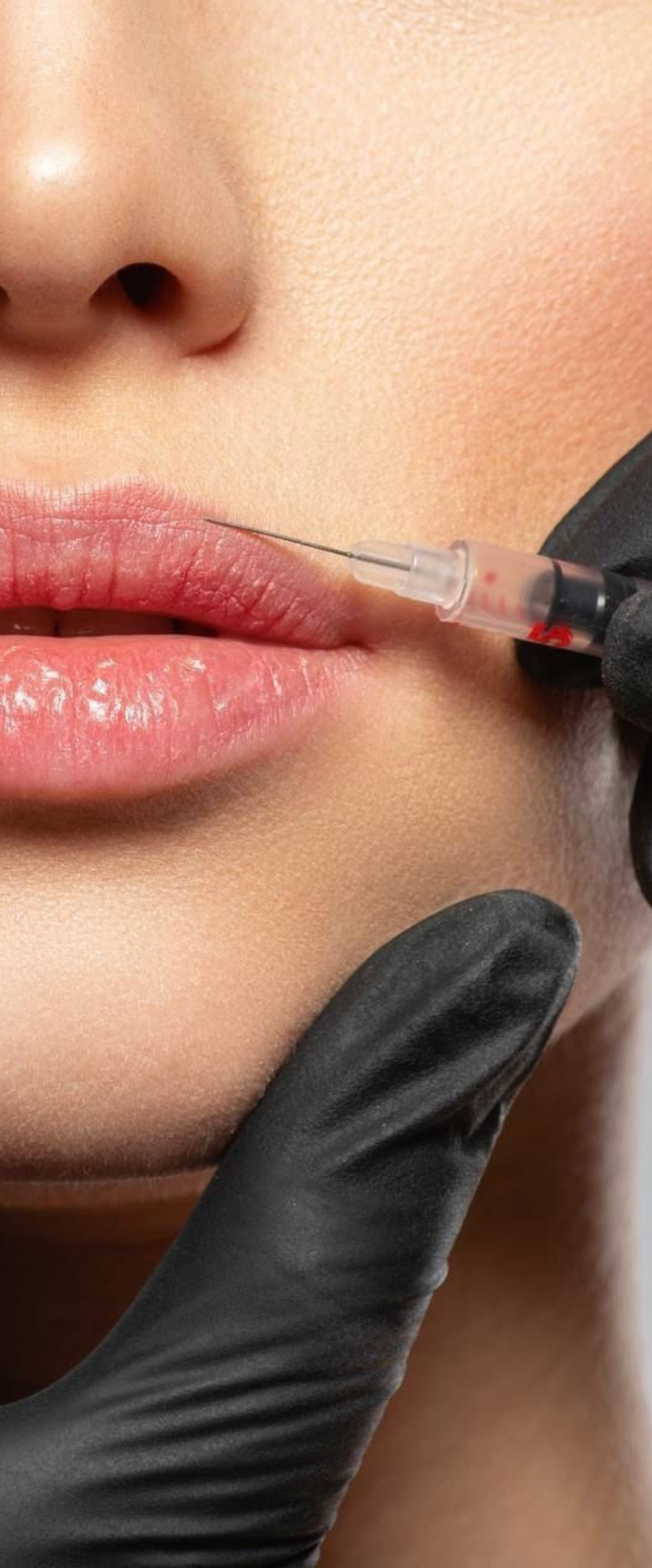 Close-up of a person receiving a dermal filler injection on their lips.
